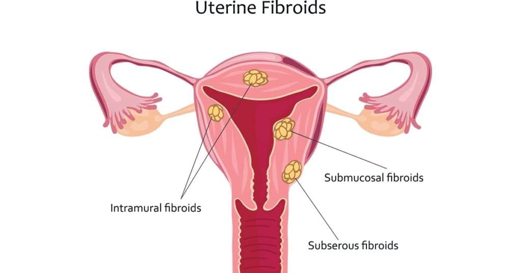 uterine-fibroids-diagram
